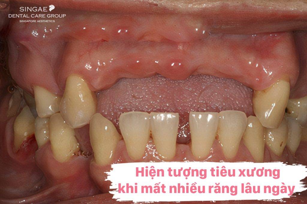 tiêu xương do mất nhiều răng lâu ngày