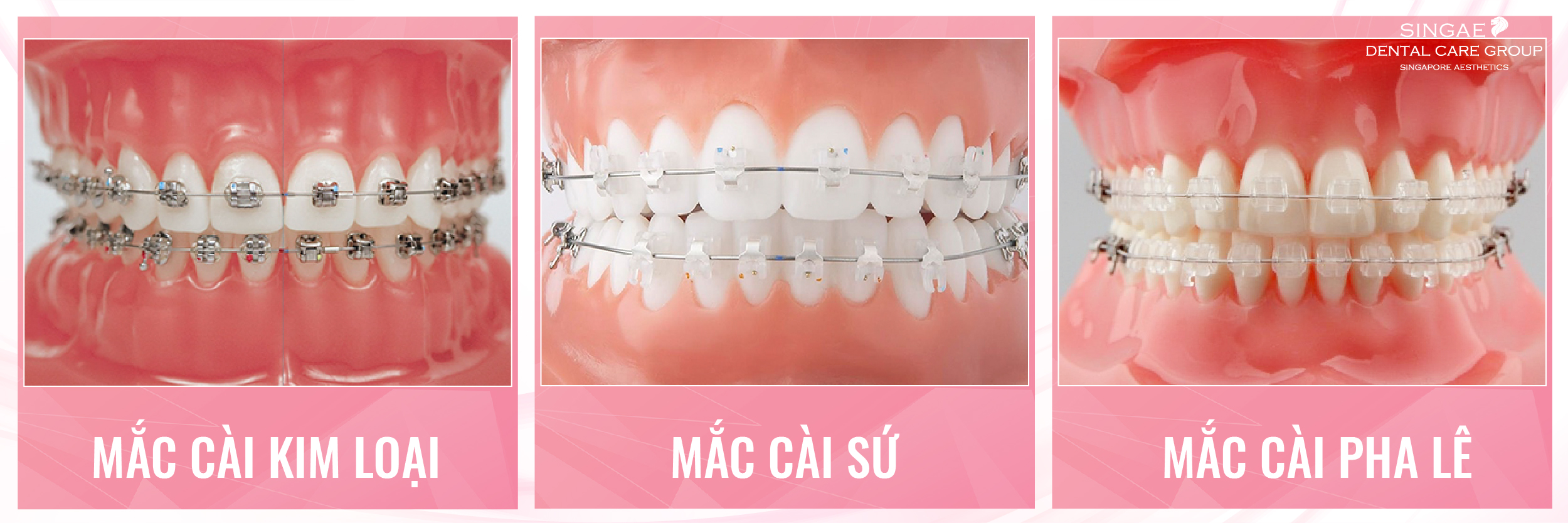 Niềng răng trong suốt Invisalign và niềng răng mắc cài ra sao?