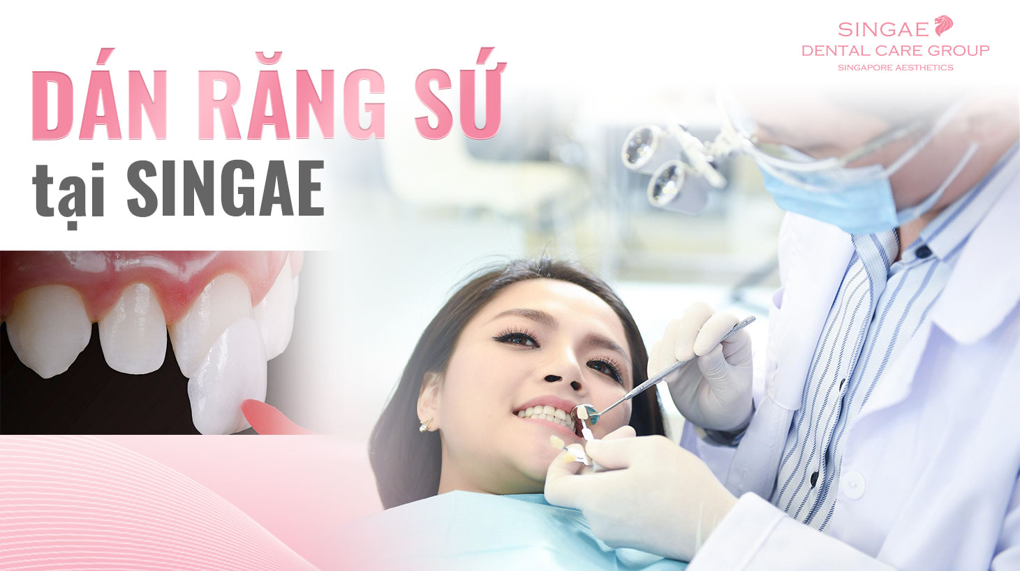 PORCELAIN VENEER SERVICE OF SINGAE DENTAL CLINIC – THE RIGHT CHOICE FOR YOU