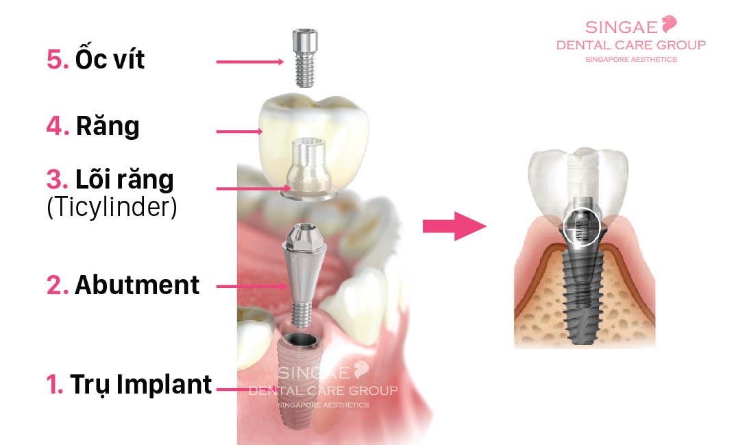 Cấu tạo của một chiếc răng Implant theo phương pháp SSI