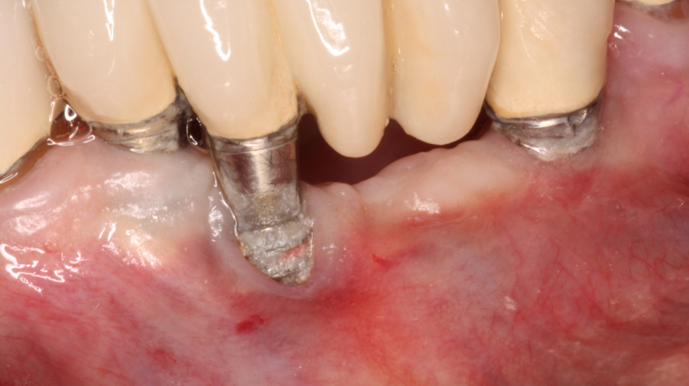 Trồng răng Implant ở đâu tốt, uy tín, chất lượng tại Hà Nội
