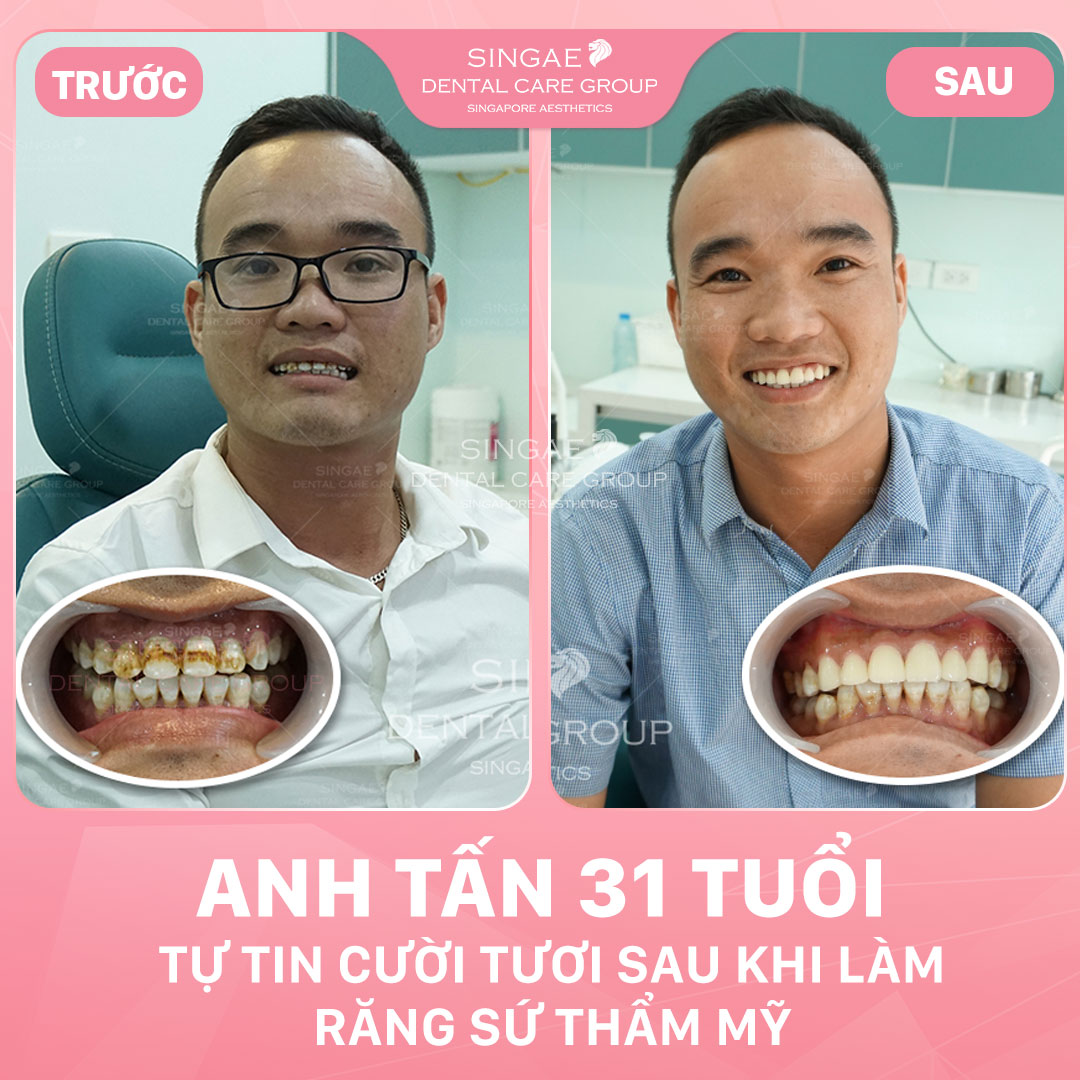Ảnh trước và sau khi đi làm răng tại Nha khoa Singae 
