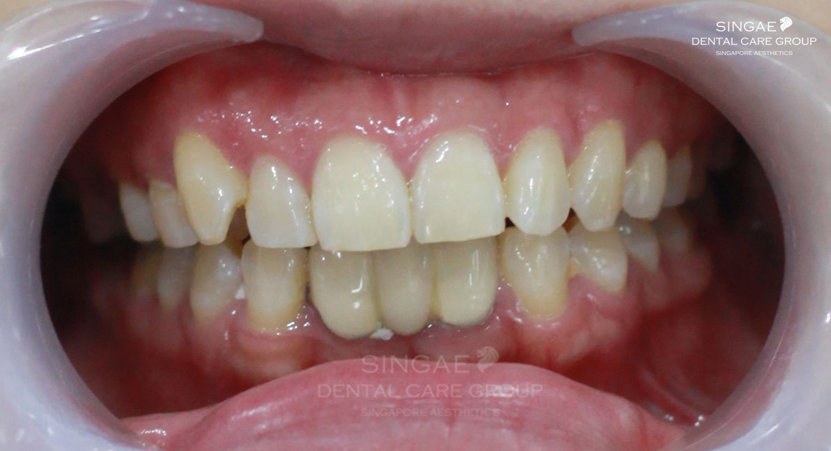 4 răng cửa hàm dưới của chị để lộ viền nướu đen 