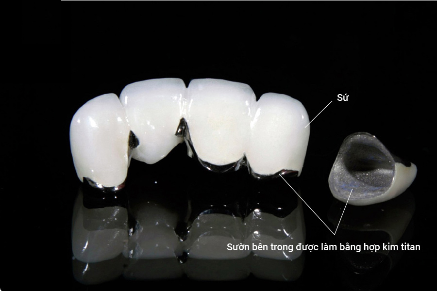 các loại răng sứ phổ biến hiện nay mà bạn nên biết