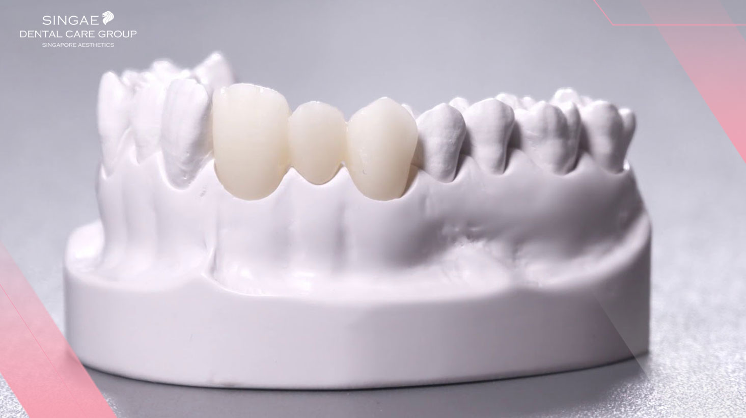 [Chia sẻ ] 6+ Điều bạn cần biết về răng sứ Cercon