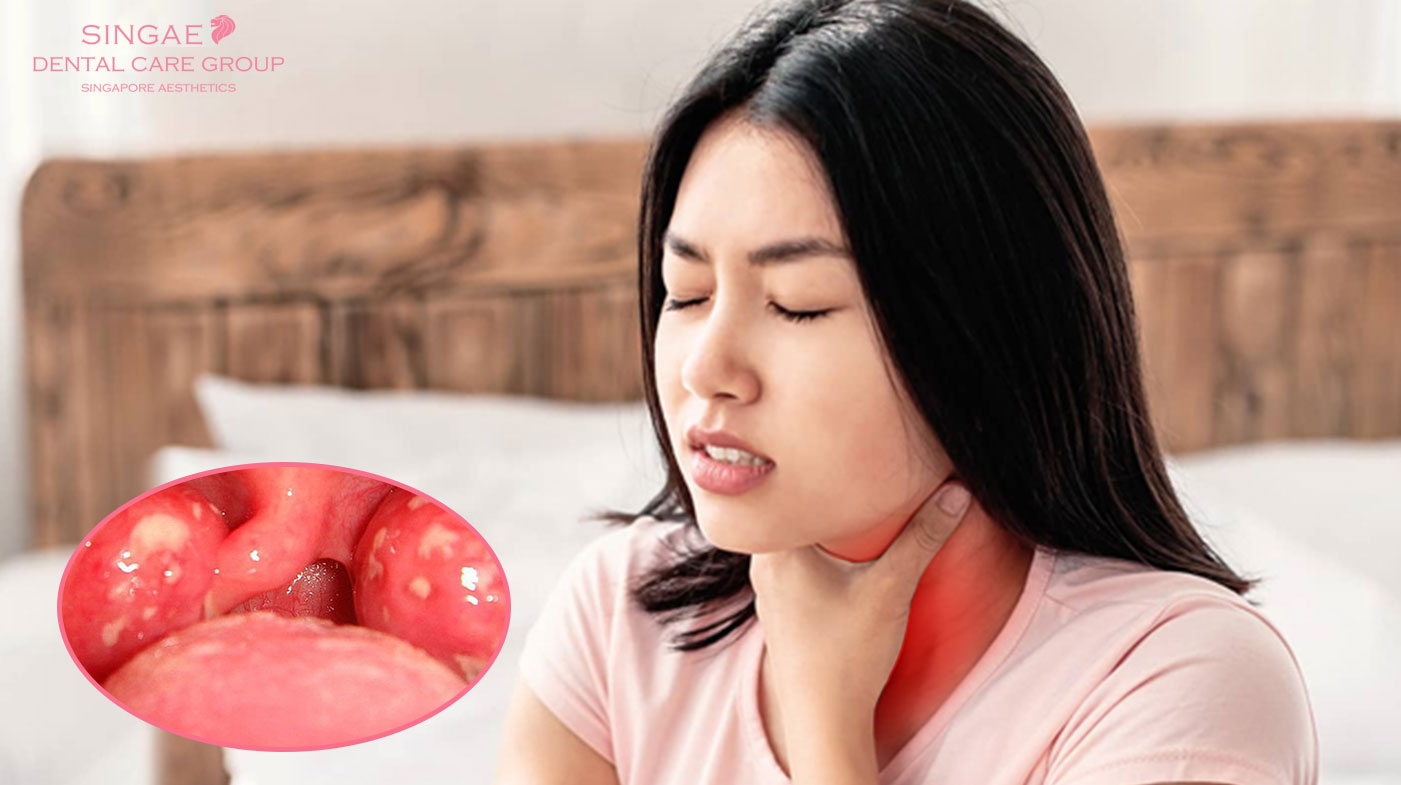 Bị hôi miệng từ cổ họng. Bạn cần biết 7 điều này để chữa dứt điểm