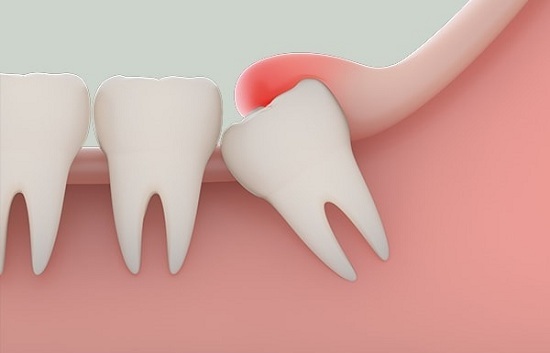 Viêm lợi, sưng lợi răng hàm là gì?
