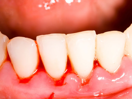 Dấu hiệu bị viêm lợi trùm: chảy máu, đau nhức chân răng