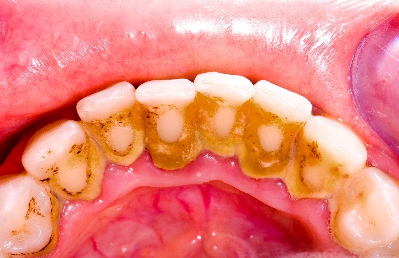 Cao răng là gì
