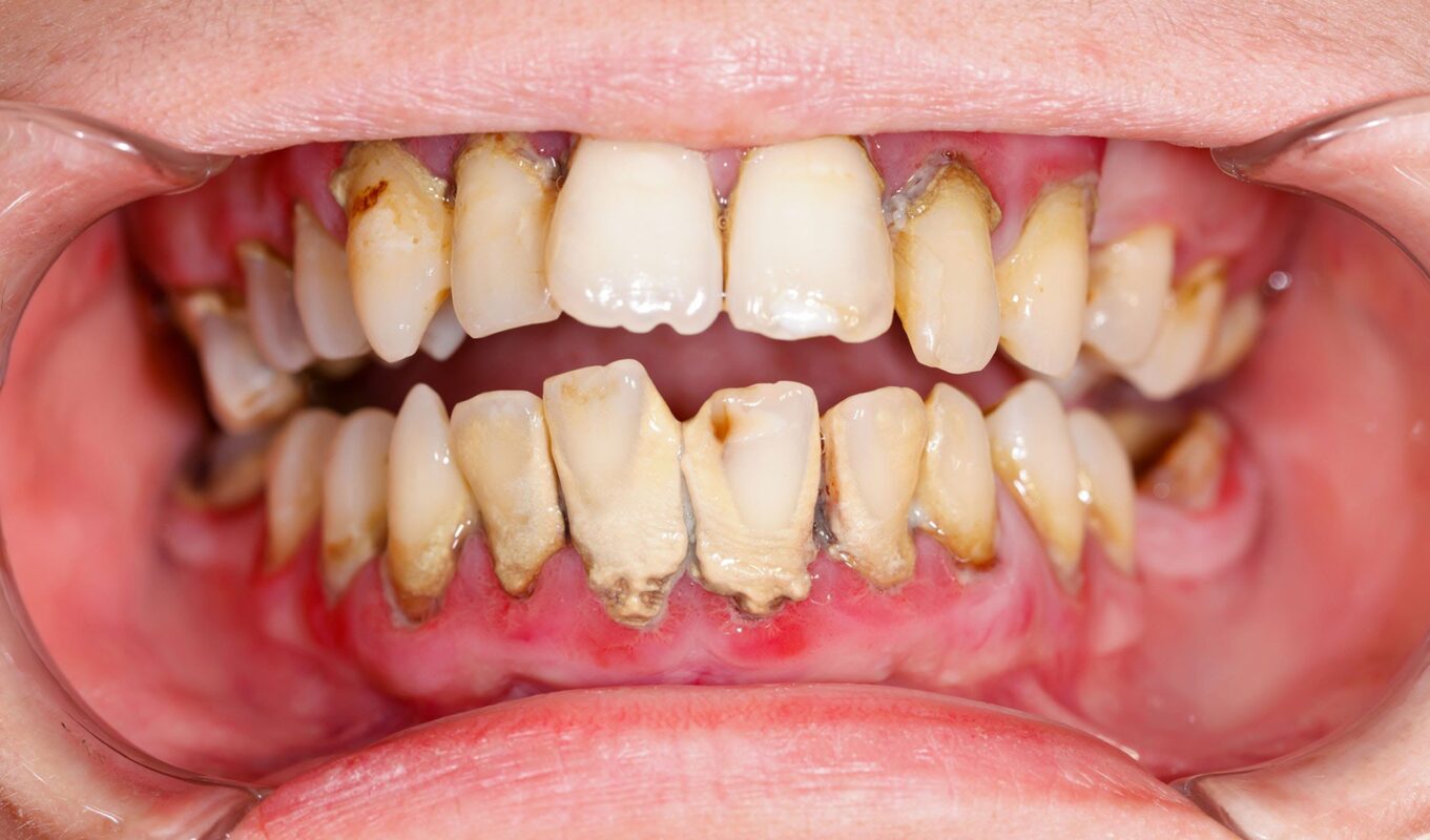 Tác hại của việc lấy cao răng 
