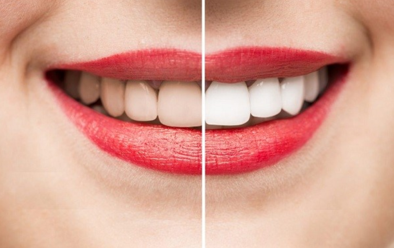 Lấy cao răng có trắng răng không? 