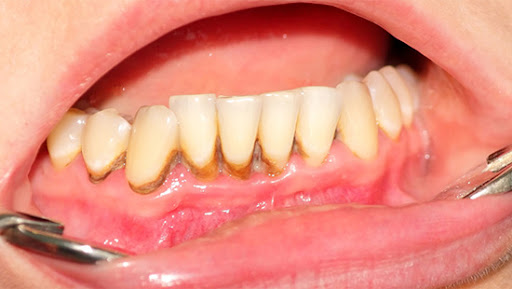 [ Kẽ răng bị đen ]: Nguyên nhân và cách điều trị