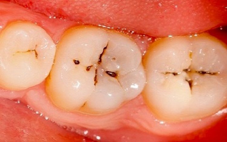 [ Kẽ răng bị đen ]: Nguyên nhân và cách điều trị