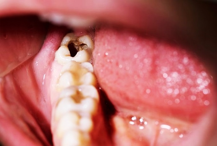 Tìm hiểu nguyên nhân dẫn đến [ Sâu răng khôn ], triệu chứng, giải pháp