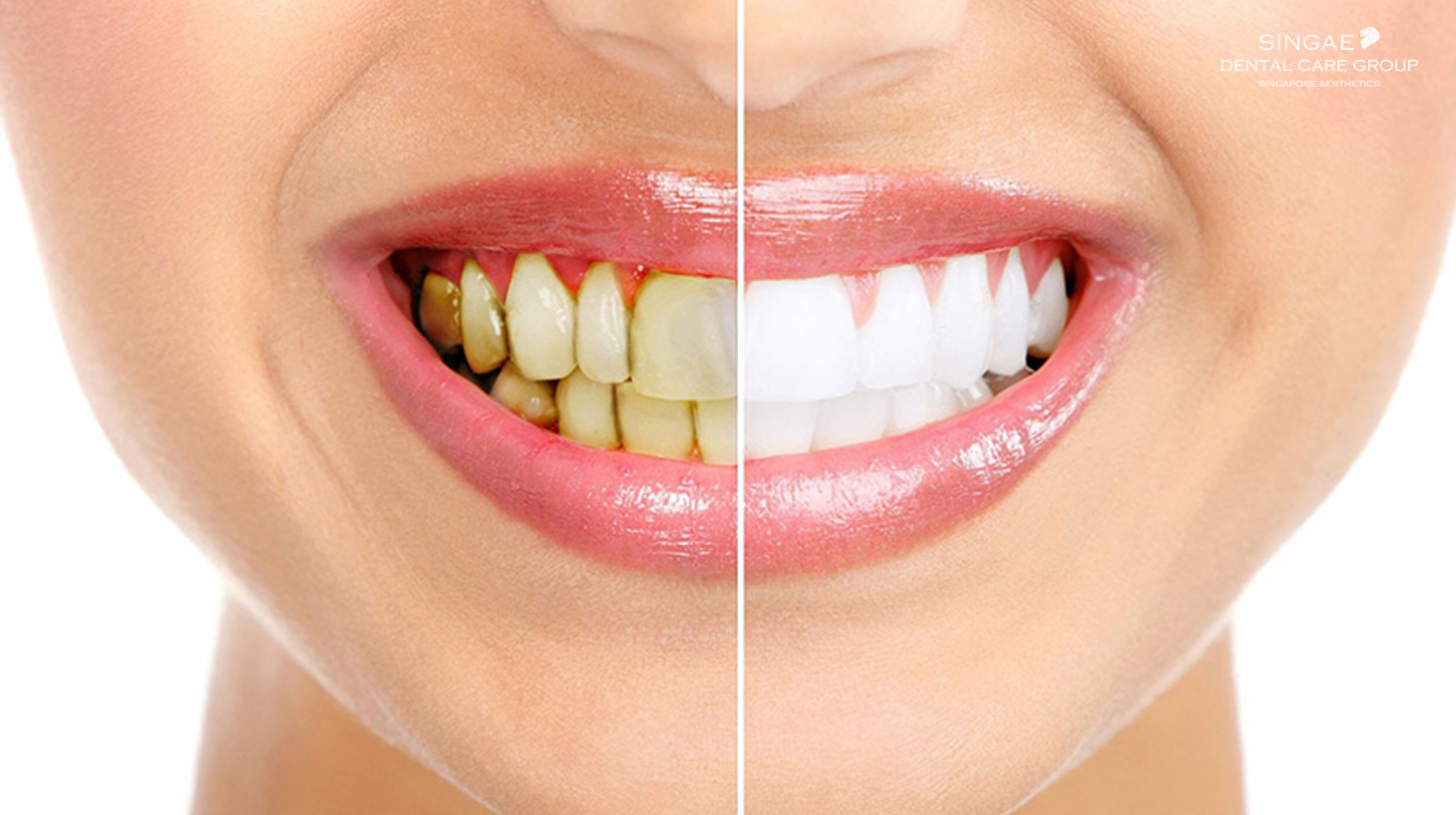 Bật mí [ các cách làm trắng răng bị ố vàng ] hiệu quả nhất dành cho bạn