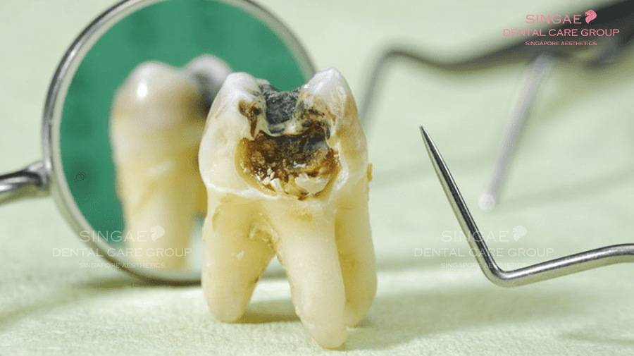 Sâu răng khôn nguyên nhân do đâu? Triệu chứng và giải pháp