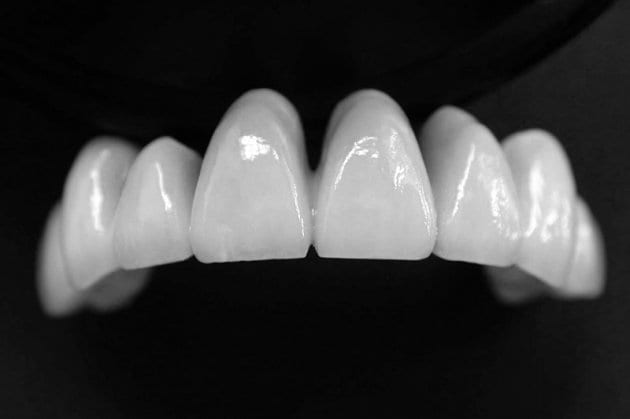Răng sứ Cercon HT và Cercon có gì khác nhau. Bảng giá bọc sứ