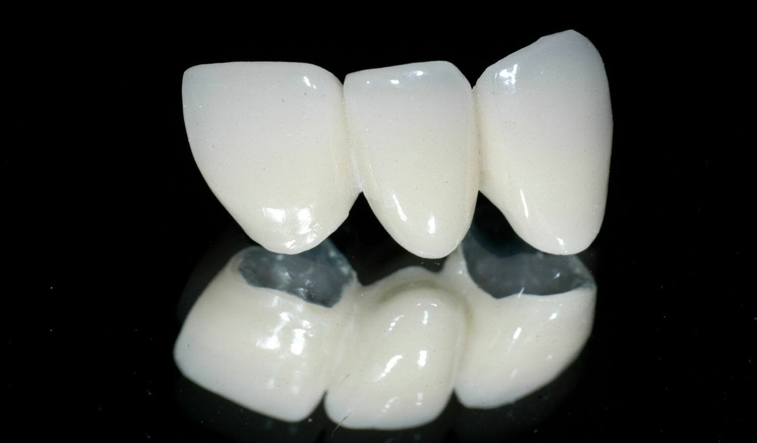 Các loại răng sứ 
