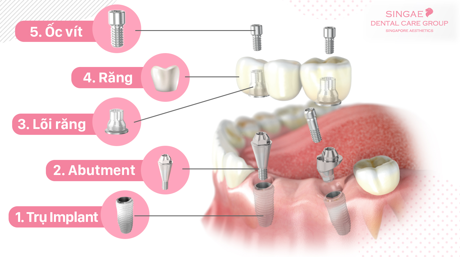 Trồng răng Implant là gì? 10 dòng trụ Implant phổ biến nhất hiện nay