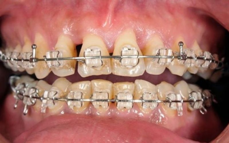 [ Có nên niềng răng không? ] Những ai nào nên niềng răng?