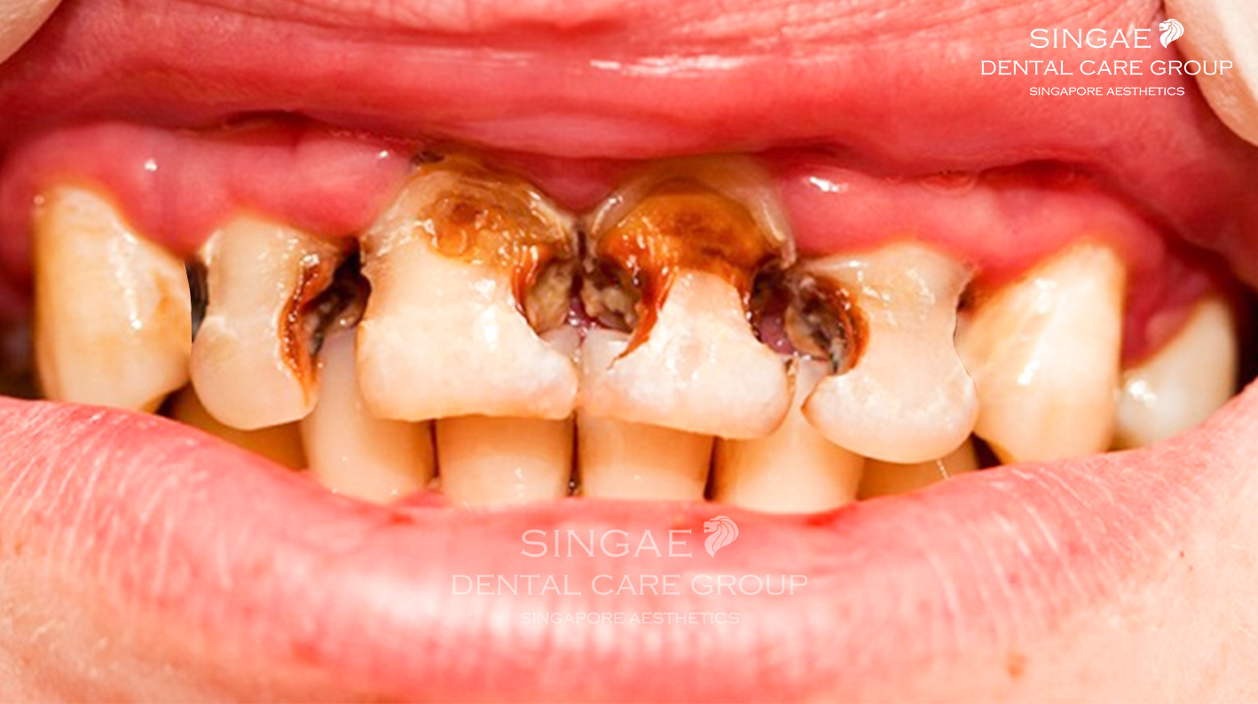 Hình ảnh viêm tủy răng và nguyên nhân triệu chứng cách khắc phục
