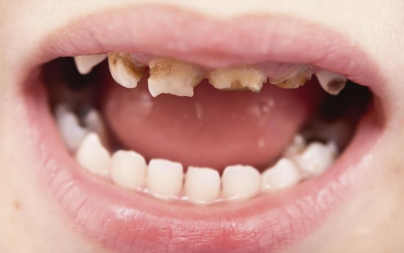Hình ảnh sâu răng theo bộ răng