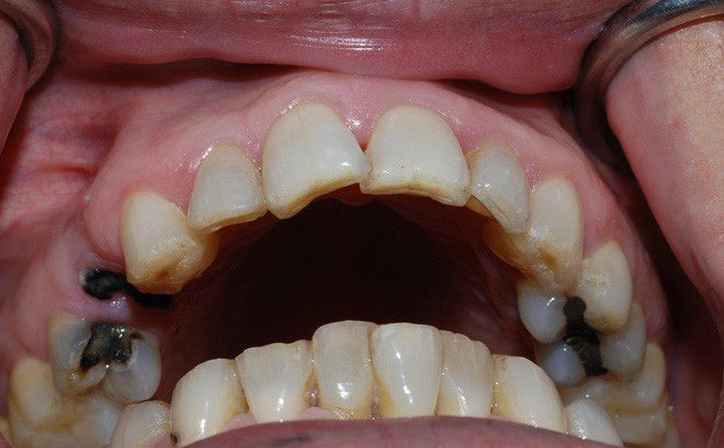 Bộ răng vĩnh viễn bị sâu