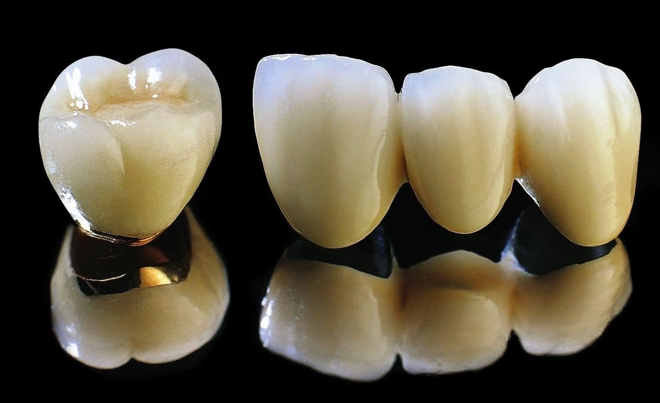 Các loại răng sứ