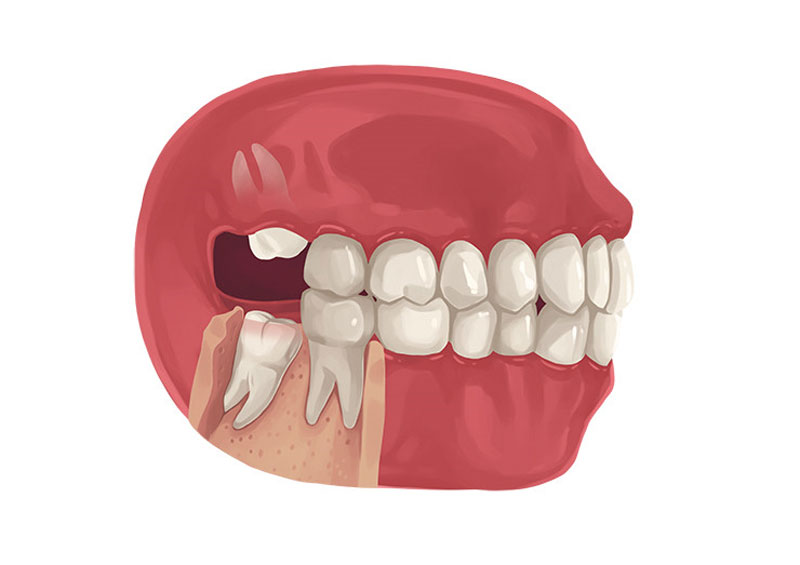 [ Răng khôn mọc lệch hàm trên? ] và những điều bạn cần biết