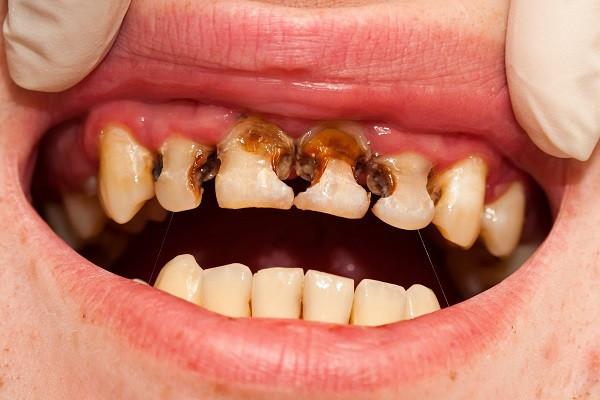 Sâu răng cửa nguyên nhân do đâu? Dấu hiệu và cách điều trị