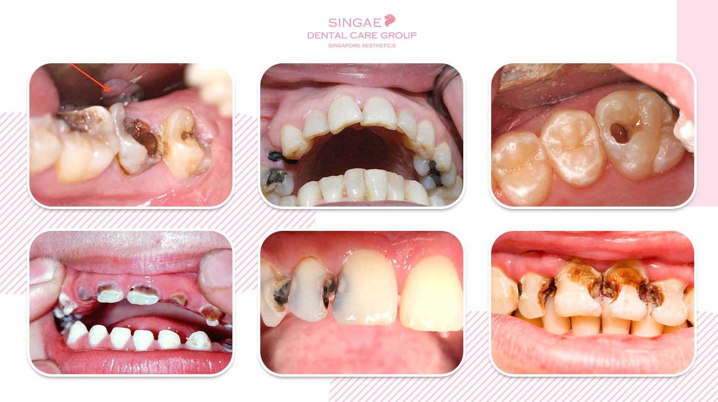20+ PICTURES OF TOOTH DECAY AT TOOTH POSITIONS AND STAGES OF TOOTH DECAY