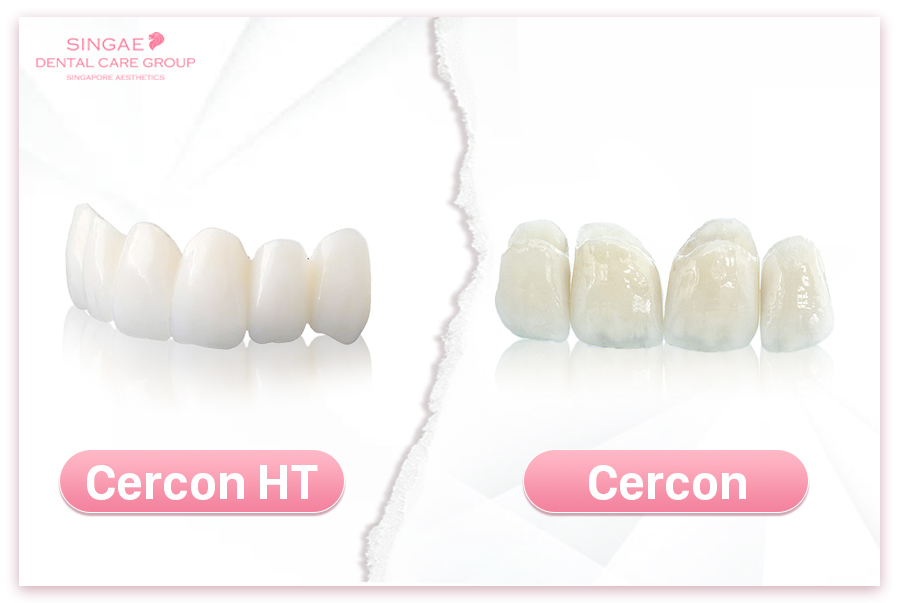 So sánh răng sứ Cercon và Cercon HT, nên bọc răng sứ loại nào? Bảng giá bọc sứ Cercon HT