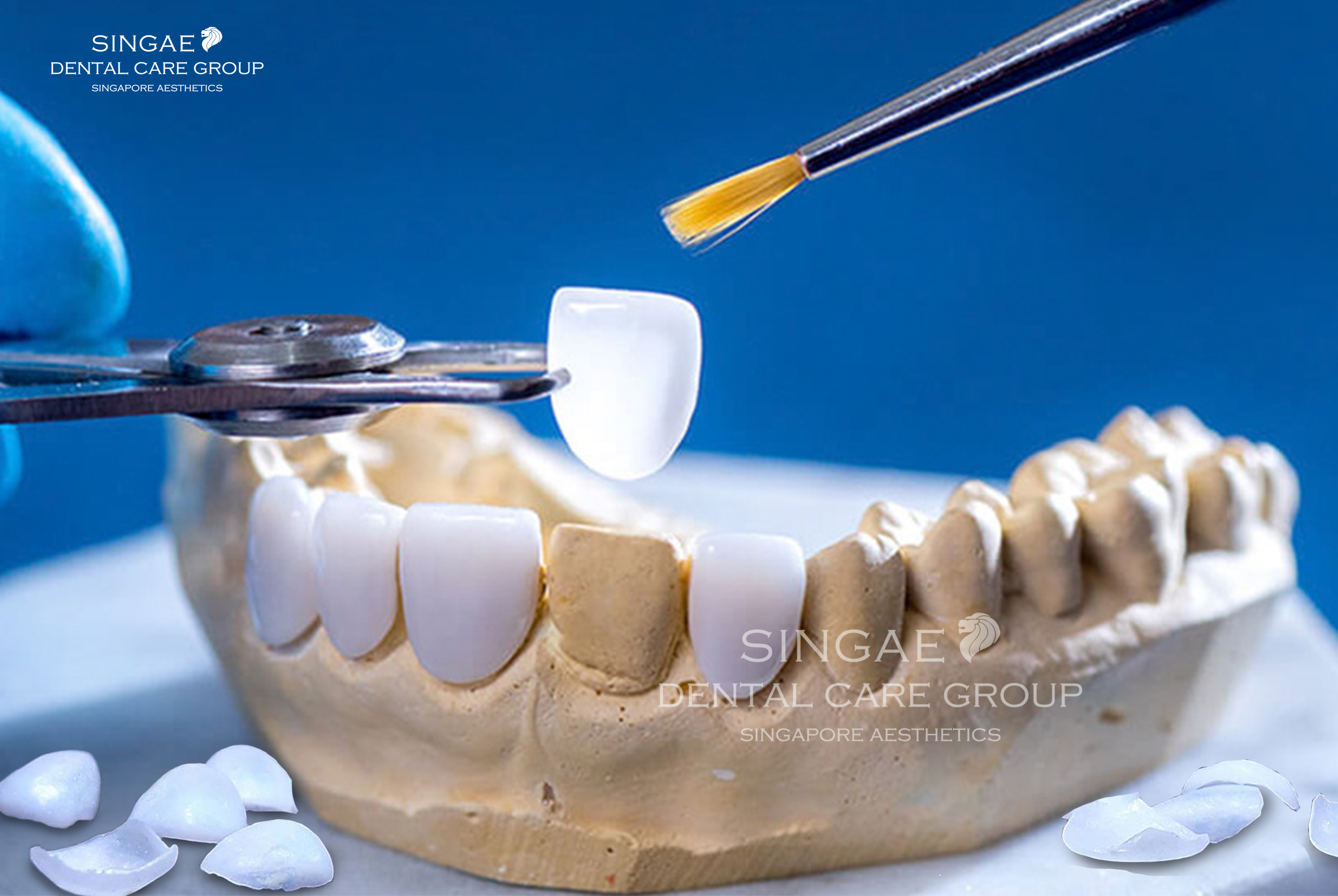 [6+] Ưu điểm nổi bật của phương pháp dán răng sứ Veneer