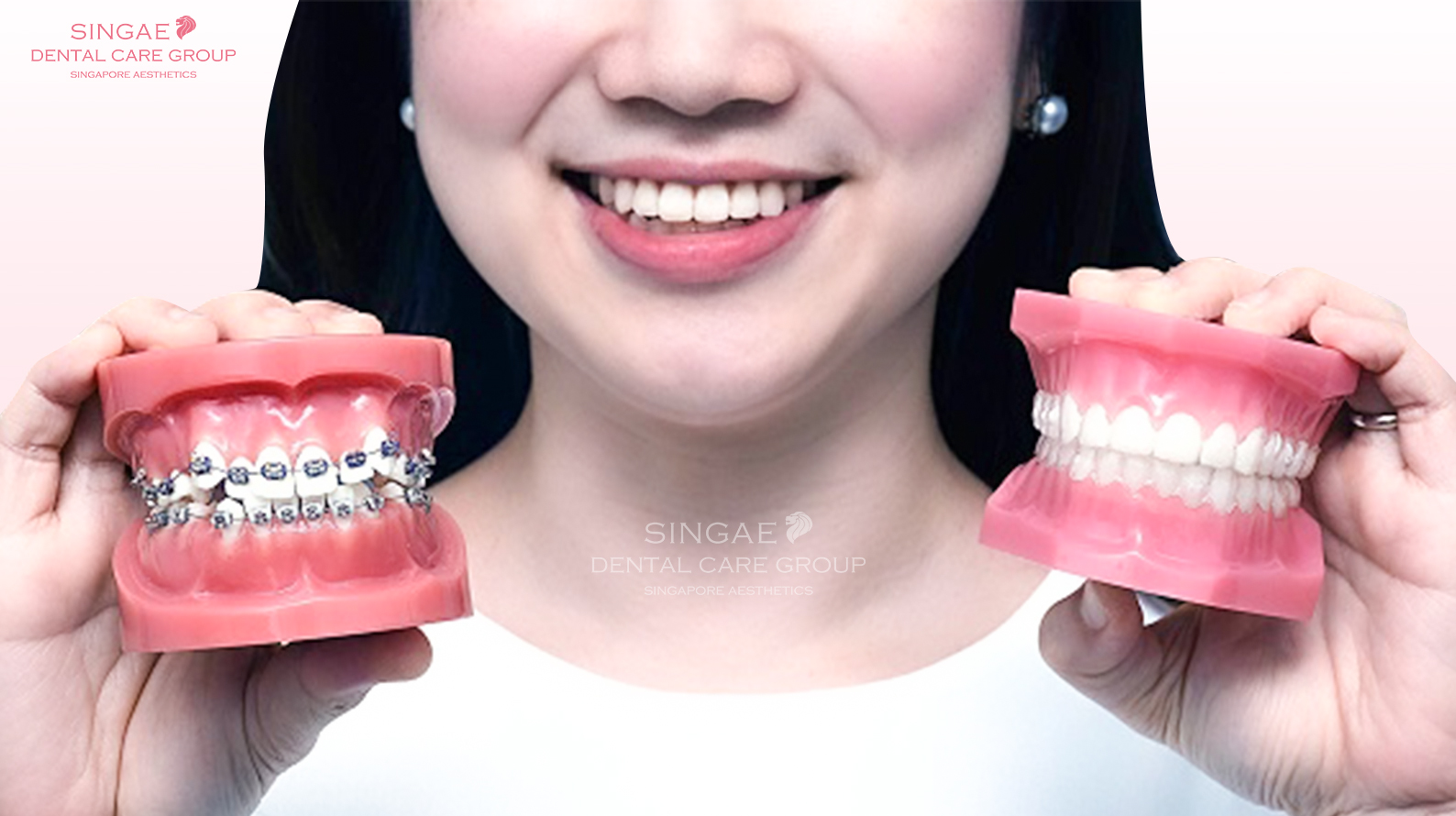 [WHAT ARE BRACES? ] AND TOP 7+ THINGS YOU SHOULD KNOW ABOUT ORTHODONTICS