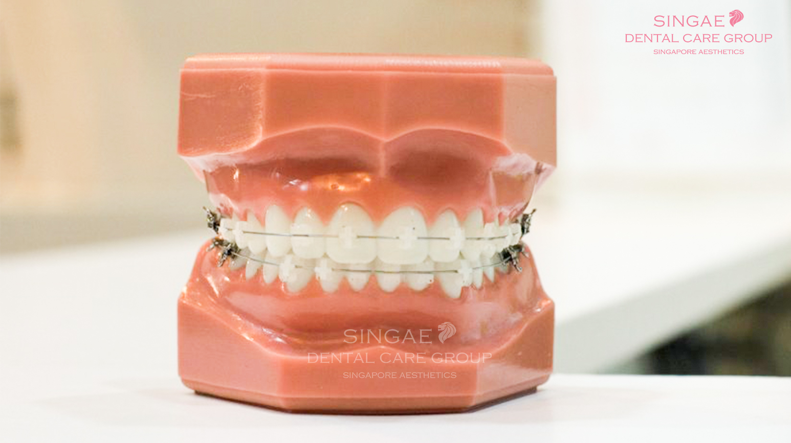 [CRYSTAL BRACES] WHAT IS AND HOW TO CARE AFTER ORTHODONTIC
