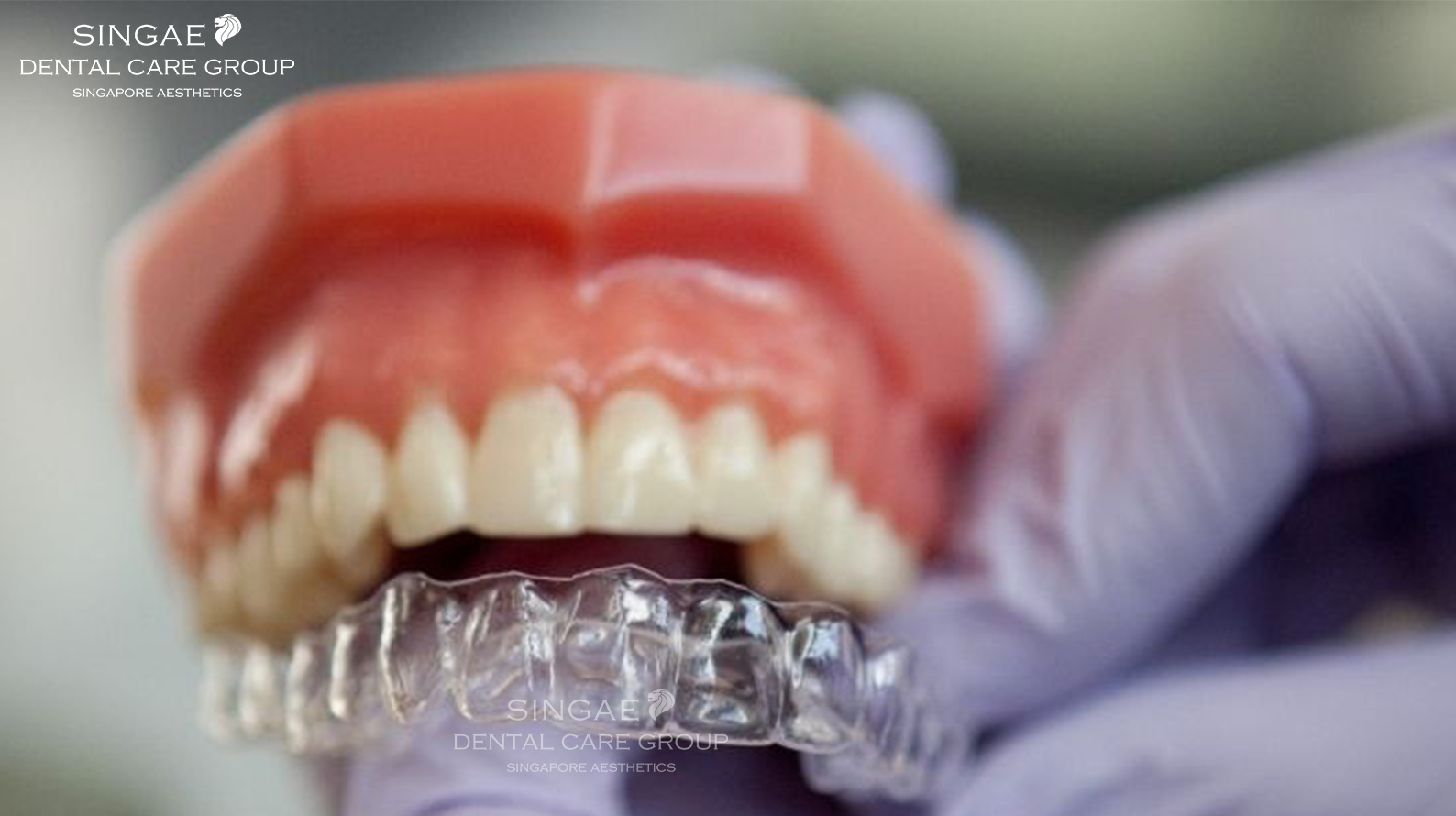[REMOVABLE BRACES] AND WHAT YOU SHOULD KNOW ABOUT THIS METHOD