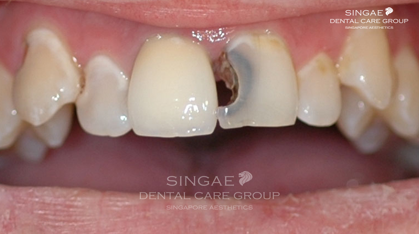 Nguyên nhân dẫn đến [sâu răng cửa] là gì? Dấu hiệu, hậu quả và cách điều trị