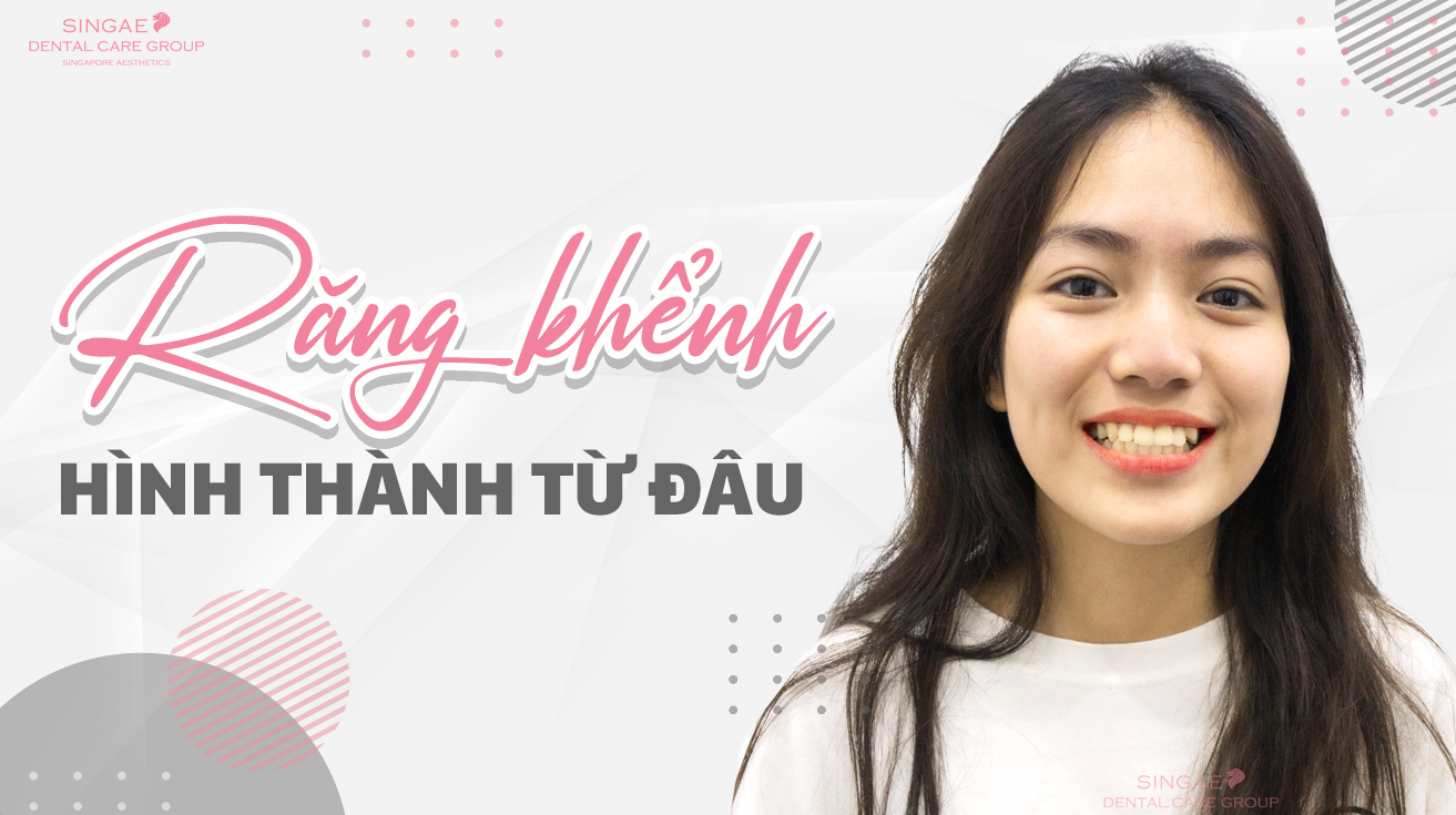 Răng khểnh là gì? Có nên nhổ hay không?