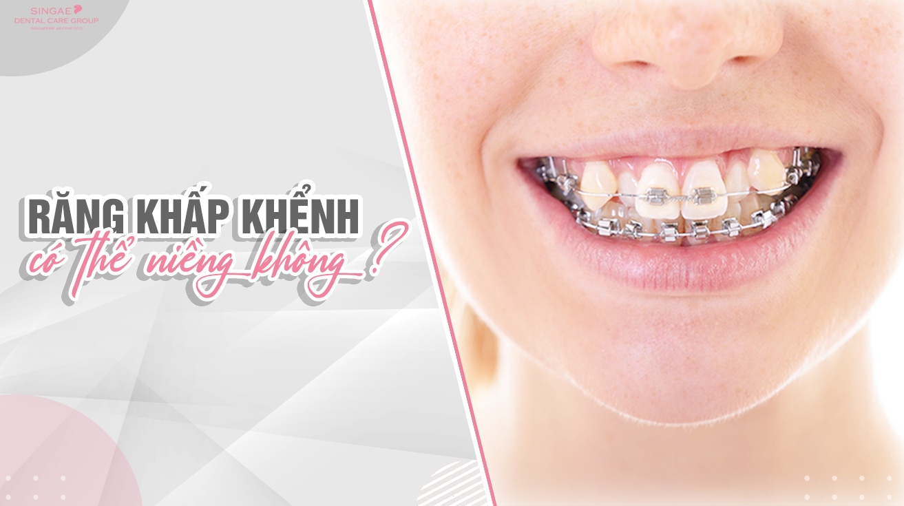 Tác hại của răng khấp khểnh và biện pháp khắc phục