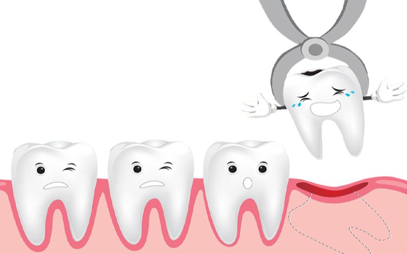Tại sao phải nhổ răng khi niềng? Có đau không, nguy hiểm không?