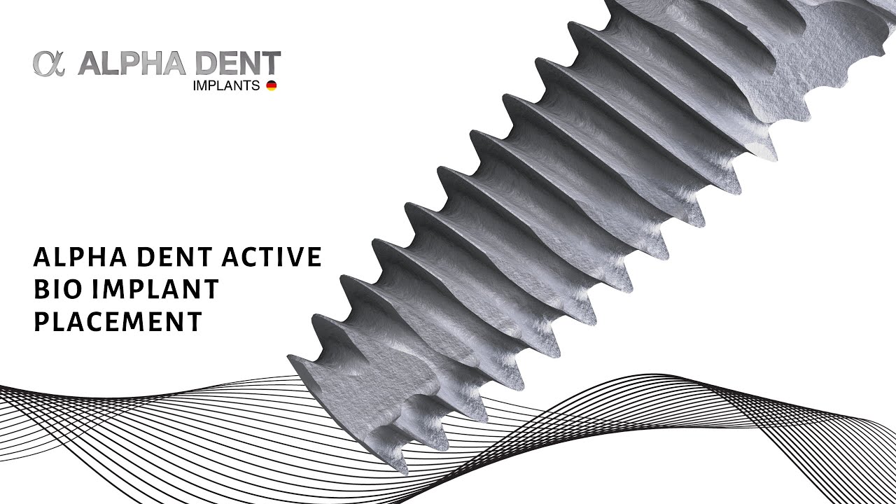 [ Trụ Implant Alphadent là gì? ]: Cấu tạo, ưu điểm, giá thành
