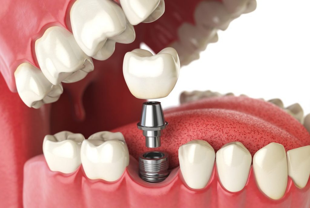 [ Trụ Implant Alphadent là gì? ]: Cấu tạo, ưu điểm, giá thành