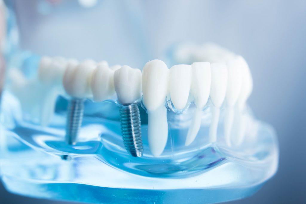 [ Trụ Implant Alphadent là gì? ]: Cấu tạo, ưu điểm, giá thành