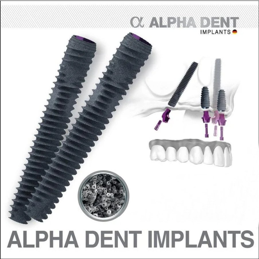 [ Trụ Implant Alphadent là gì? ]: Cấu tạo, ưu điểm, giá thành