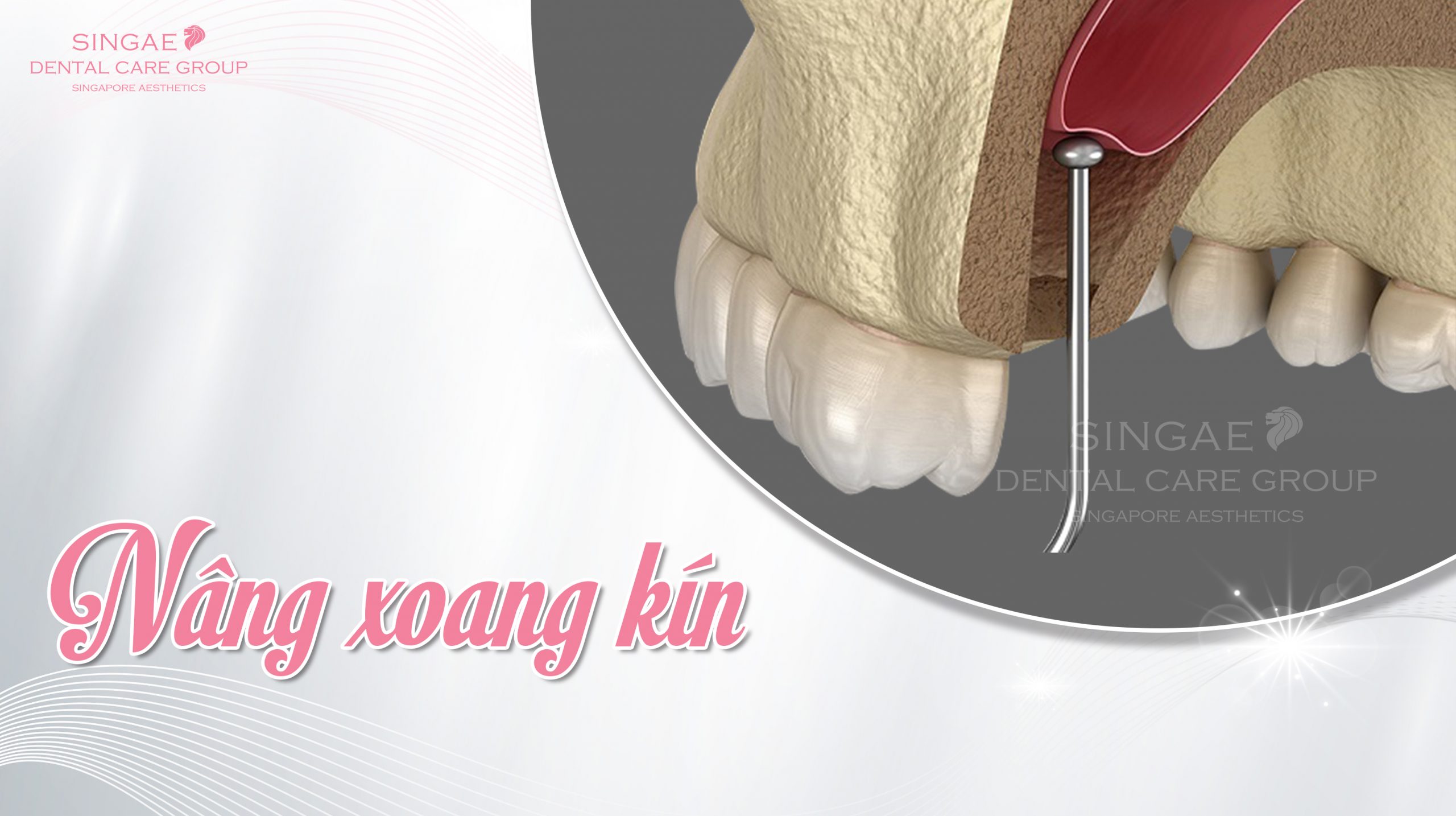 Nâng xoang kín là gì? Khi nào cần nâng xoang kín?