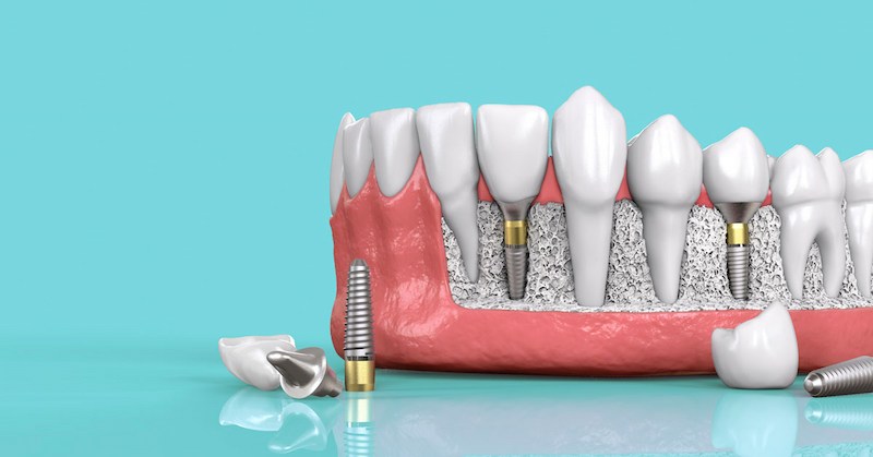 Cấy ghép Implant có chụp cộng hưởng từ MRI được không? 4 Cấy ghép Implant có chụp cộng hưởng từ MRI được không?