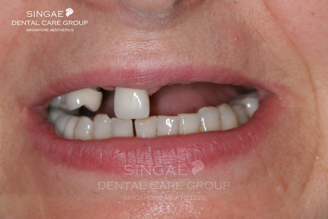 Mất nhiều răng: Nguyên nhân, hậu quả và cách khắc phục