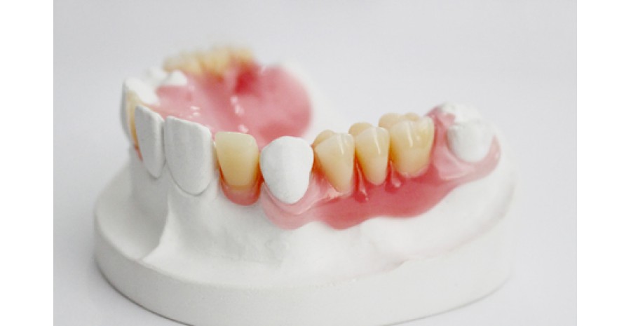 Mất nhiều răng: Nguyên nhân, hậu quả và cách khắc phục