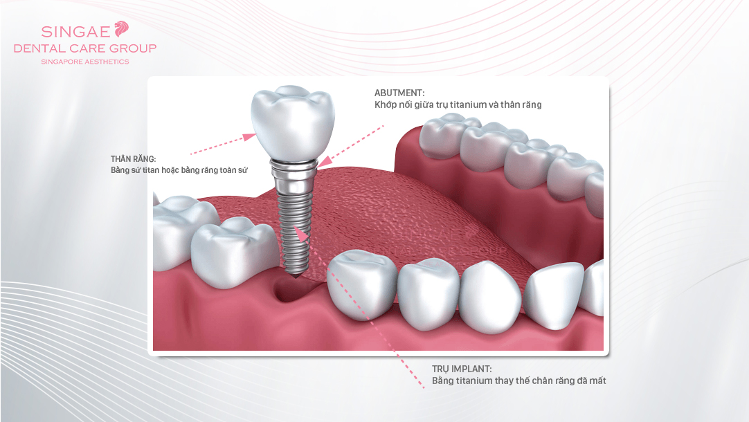 So sánh 3 phương pháp Cấy ghép Implant, Hàm tháo lắp và Cầu răng sứ