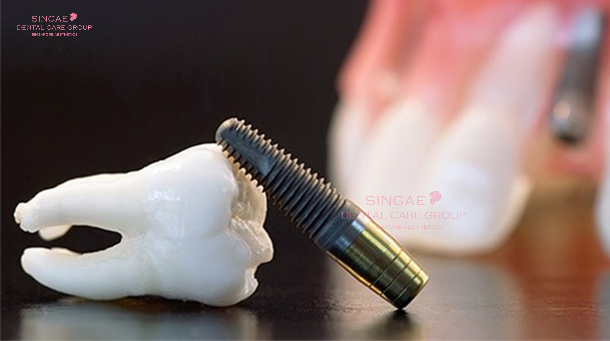 Trụ Implant bị lung lay: Nguyên nhân, Cách khắc phục